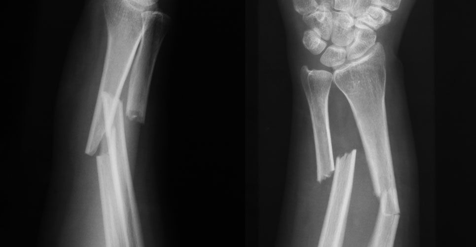 Bone Fracture Detection