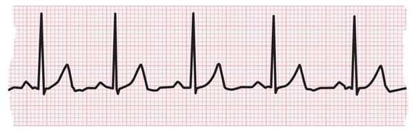 ECG Analysis