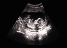 Ultrasound Analysis
